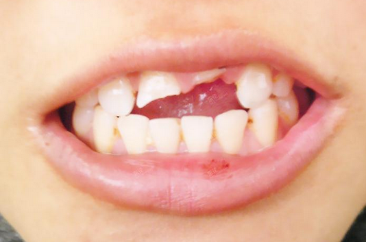 乳牙的萌出有何规律 乳牙稀疏是一种什么现象