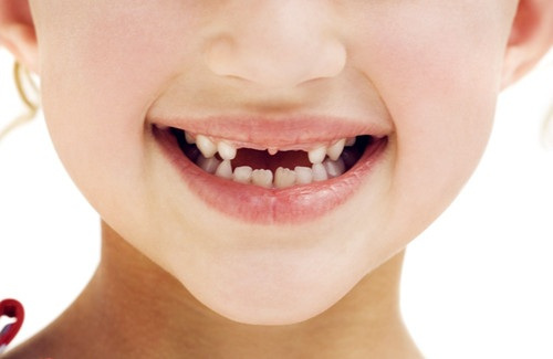 乳牙过早缺失会造成什么后果 乳牙过早缺失应采取什么相应措施