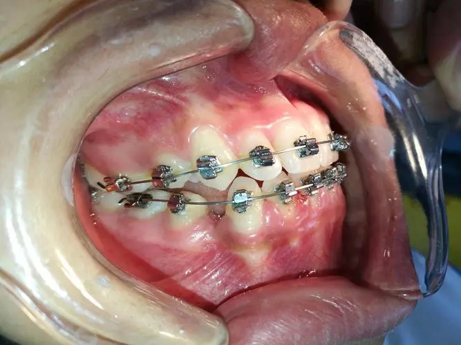 自1970 年提出以来,直丝弓矫治技术及其相应的托槽和带环几经改进和