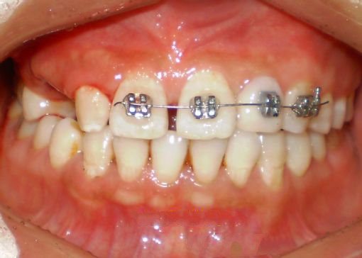 牙间隙是怎么形成的 牙间隙如何矫治