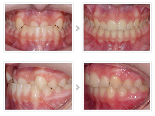 乳牙反颌有必要进行矫治吗 乳牙反颌应该在什么年龄矫治最合适