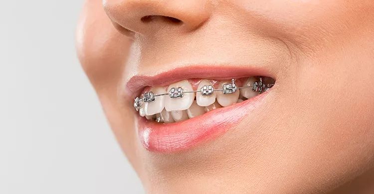 正畸治疗如何为缺牙患者创造更好的修复条件