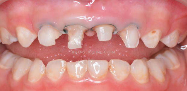 缺牙不镶有什么危害