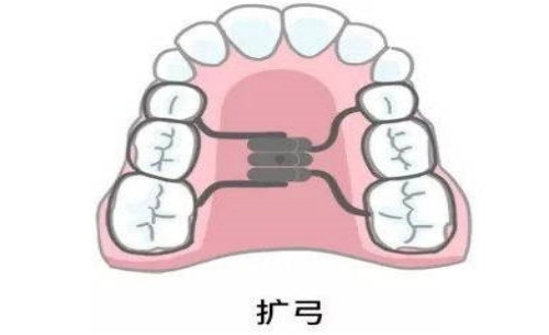 什么是慢速扩弓 什么是快速扩弓