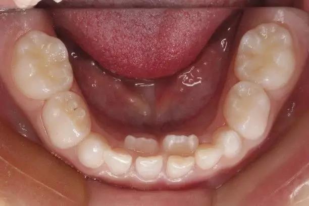 如何保护儿童的乳恒牙替牙期