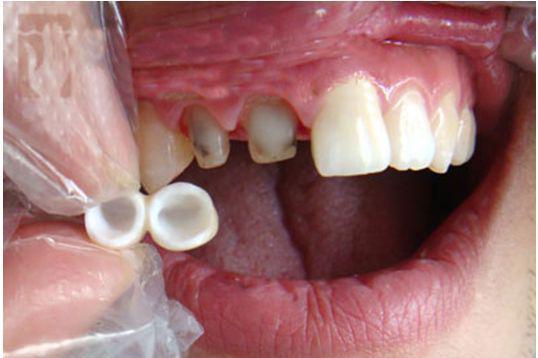 烤瓷牙适用于哪些情况 烤瓷牙有哪些种类