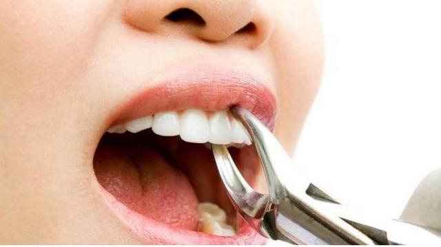 牙齿拔除后有什么注意事项