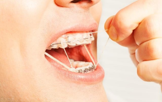 进行正畸治疗会有后遗症吗 牙齿矫正治疗后为什么还需要保持
