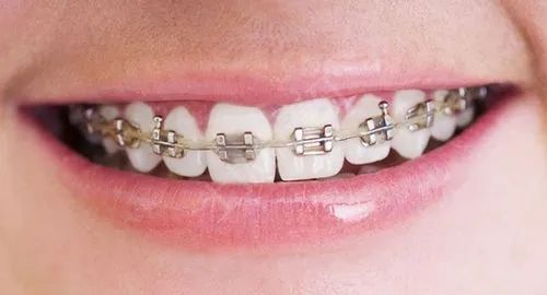 牙齿矫正过程应如何配合