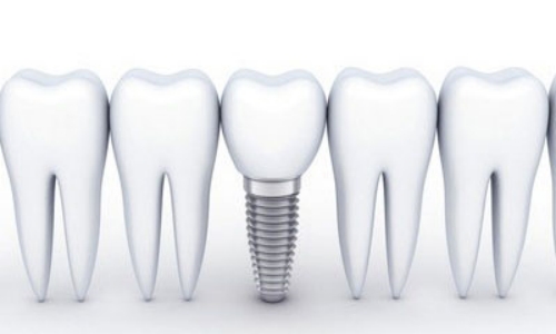 吸烟为什么是种植牙最大的敌人