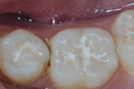 窝沟封闭是什么 什么时候进行窝沟封闭