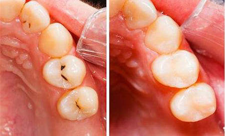 树脂补牙能用多久