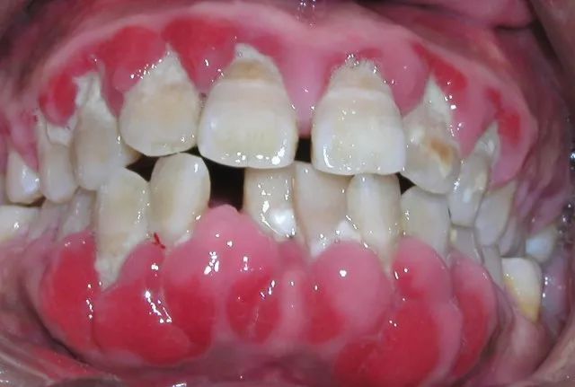 如何进行牙周病的早期预防和治疗