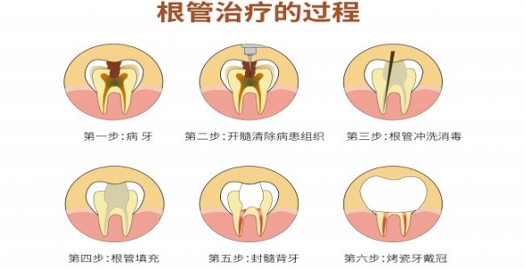 什么是显微根管治疗 根管治疗后为何要用牙冠修复