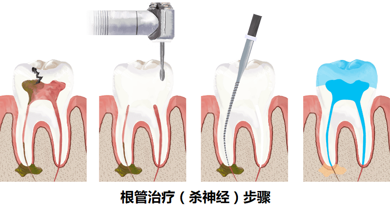 为什么要“杀神经” “杀神经”有什么利弊