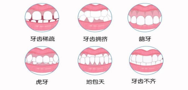 牙颌畸形矫治疗程一般有多长 牙颌畸形的矫治费用需多少