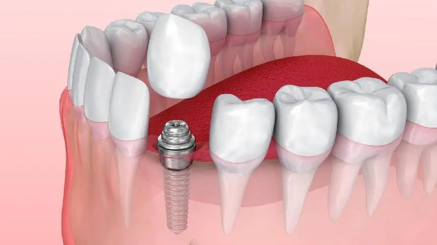 口腔种植的维护与保养