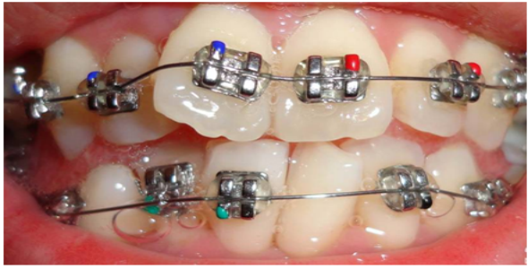 戴用固定矫治器会不会造成牙釉质脱钙