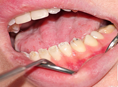 拔牙矫治通常选择拔除哪些牙齿 为什么一般情况下不应拔除“虎牙”