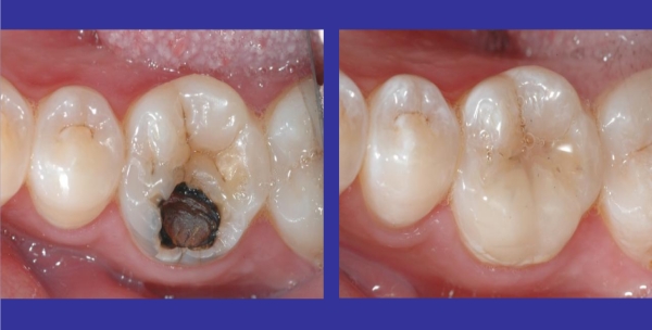 牙体修复的美学是什么