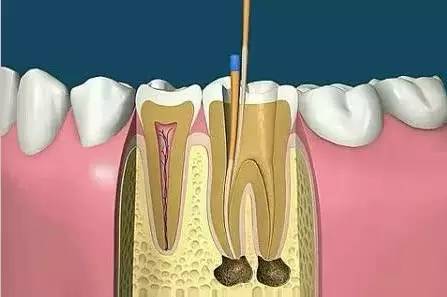 根管治疗的适应证是什么