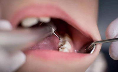 根管治疗的治疗过程是什么样的