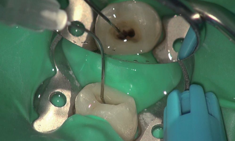 根管治疗再感染该怎么办