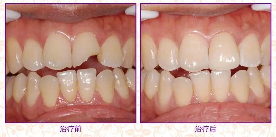 青少年期牙列缺损和牙列缺失治疗