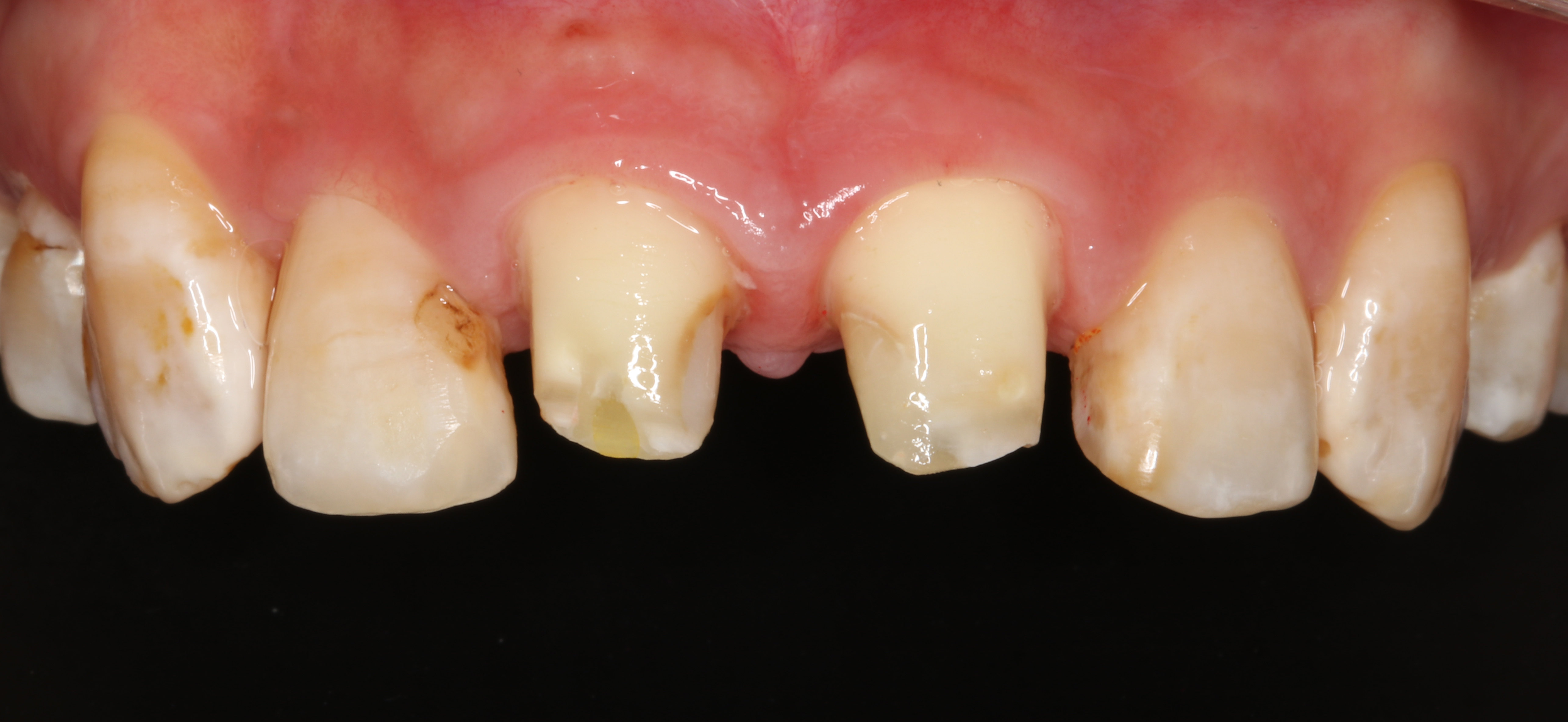 牙体缺损有什么影响