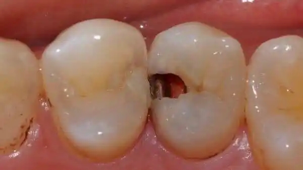 死髓牙可以做正畸治疗吗