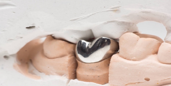 常用的人造冠种类有哪些