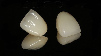 各种烤瓷牙的优缺点各有哪些