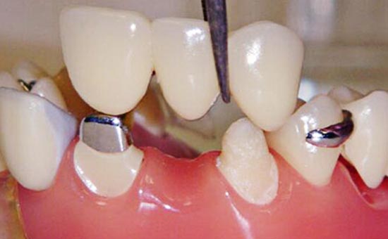 烤瓷牙内的牙齿发生疼痛是否需要拆冠 做了冠套后食物嵌塞怎么办