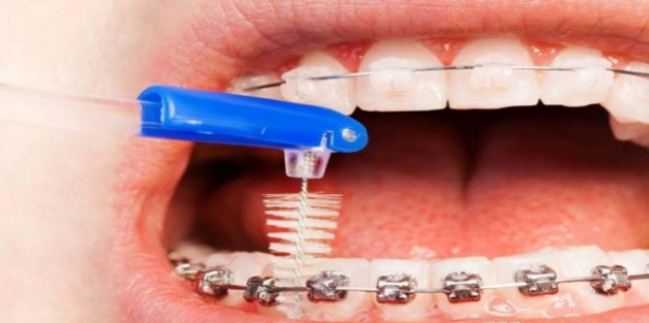 正畸期间正确的牙齿清洁方式
