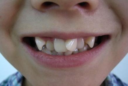 牙齿排列不齐有无危害