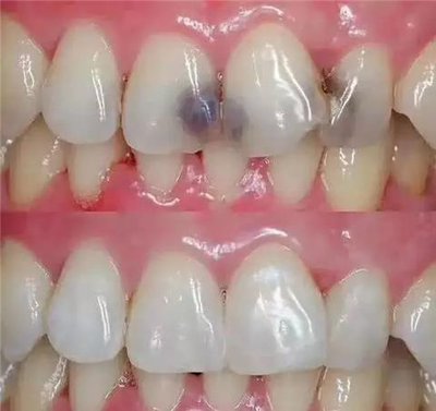 补牙有哪些材料