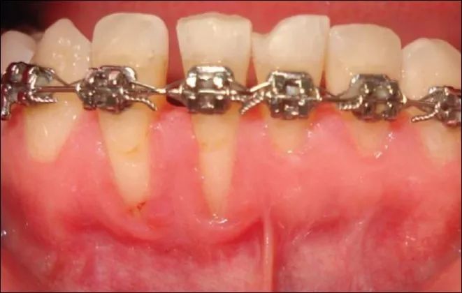 牙周病牙齿的正畸治疗