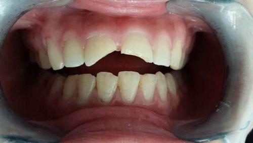 折断牙非拔不可吗