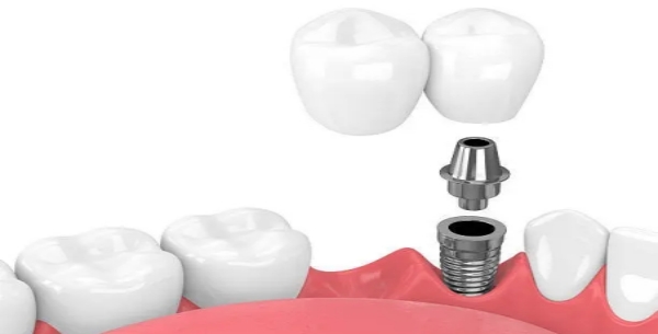 种植牙的修复步骤是怎么样的