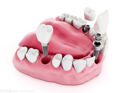 种植牙的修复治疗原则是什么