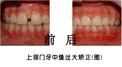 上颌门牙靠不拢是怎么回事