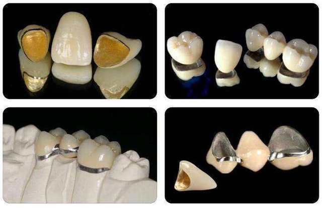 烤瓷牙有什么种类