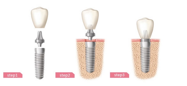 缺牙修复的高新技术--人工种植牙