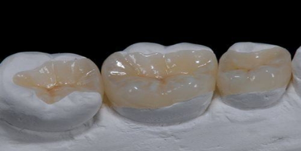 嵌体修复的步骤是什么 嵌体修复的注意事项