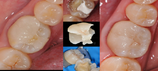 牙体缺损修复后可能出现的问题及处理
