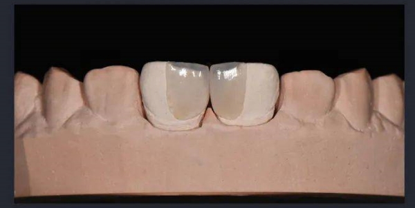 什么是烤瓷贴面修复