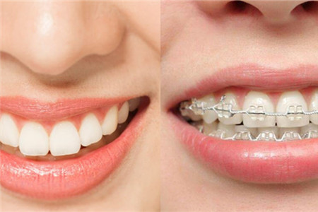 口腔正畸学中的审美艺术