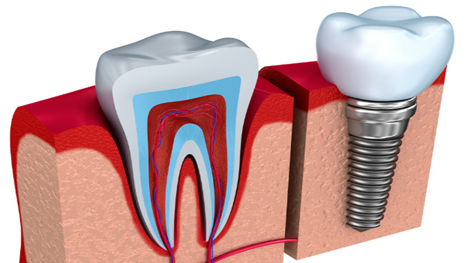 种植牙有哪几种方式