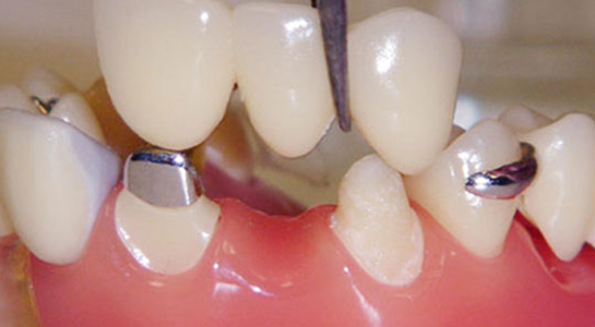 牙列缺损的固定义齿修复