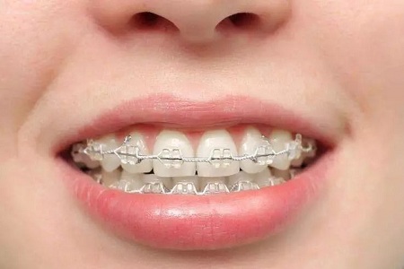 牙齿矫正有没有副作用
